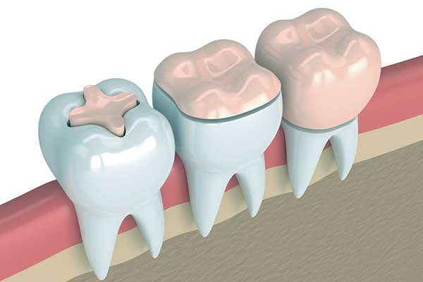 Otturazioni dentali