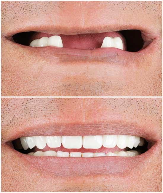 cosmetic denture a1 5