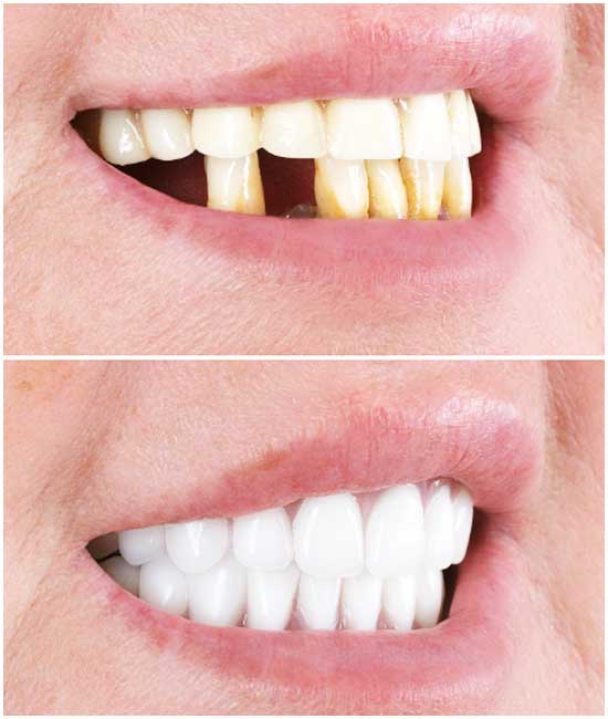 cosmetic dentures bl2