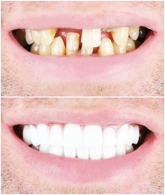 dental bridge front teeth bl2