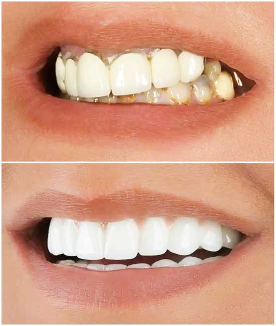 dental crown b1 888