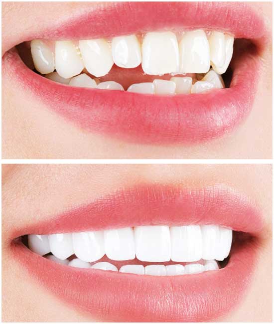 dental crown dct white® 456