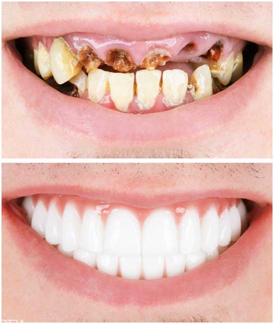 dental implant 63