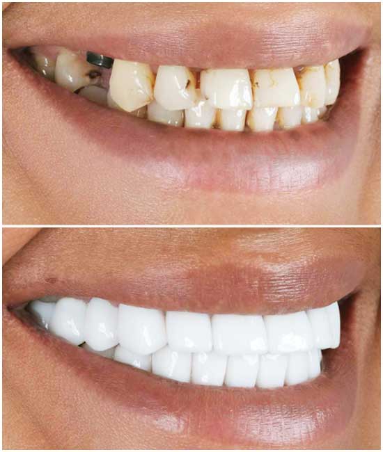 dental implant 8745