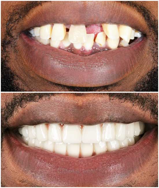 dental implant 88