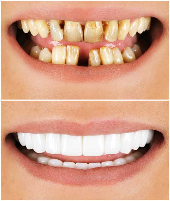 dental implant 987