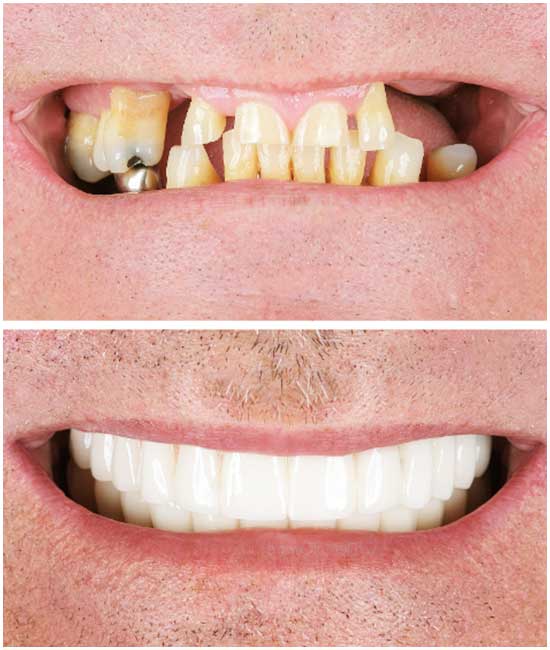 dental implant a1 87