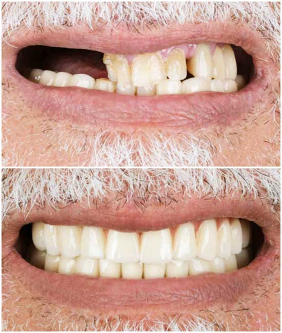 dental implant a1 89