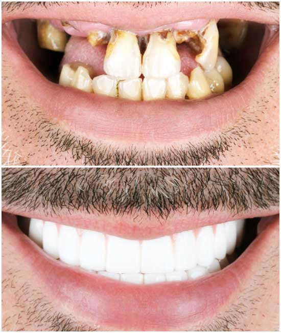 dental implant a3