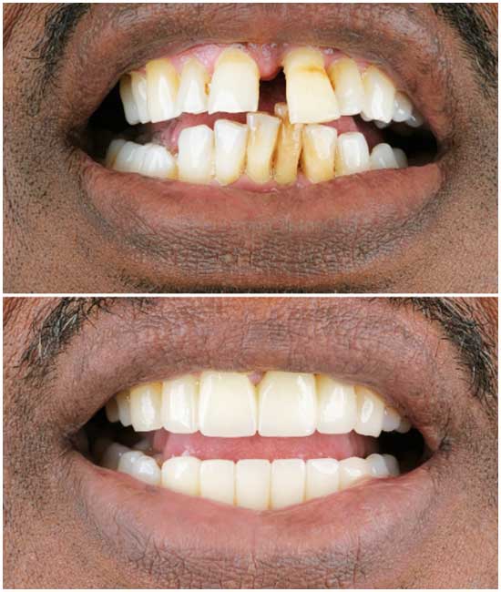 dental implant bl2 777