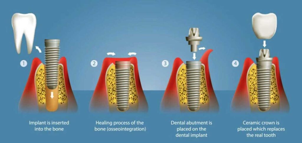 مرحله و جدول زمانی ایمپلنت دندان