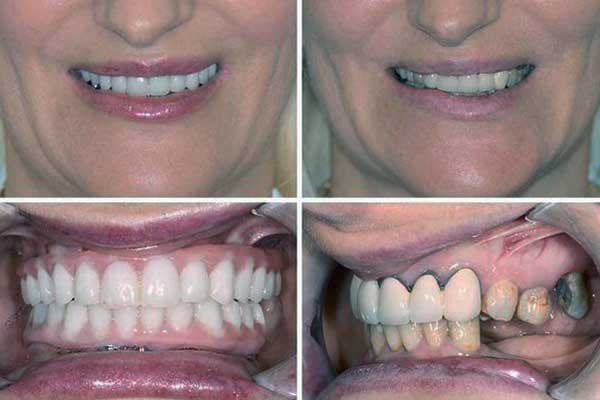 impianti dentali a bocca intera