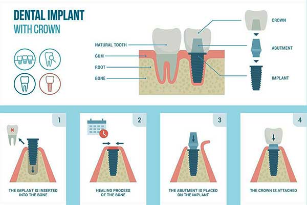 ¿Cuál es el proceso de los implantes de circonio?
