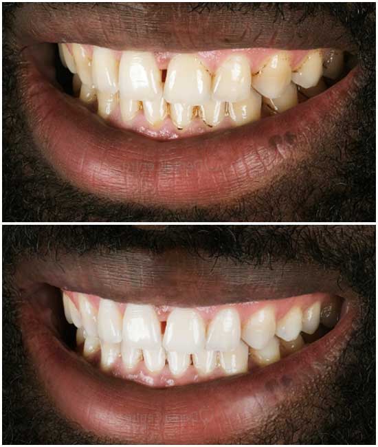 teeth whitening 22