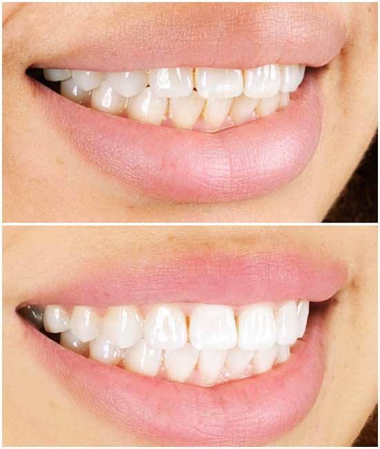teeth whitening 654123