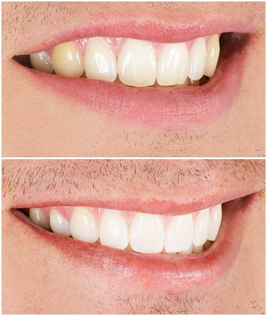 teeth whitening dentist 451