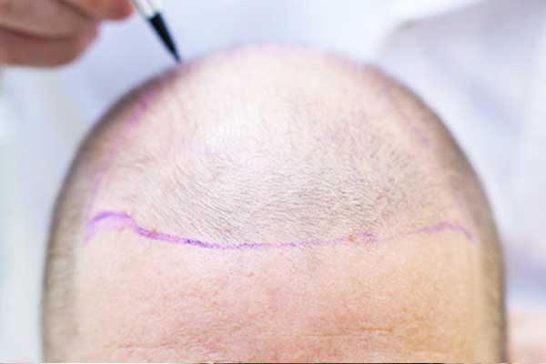 زراعة الشعر بالاقتطاف (FUE): تقنية حديثة لتحسين مظهرك وزيادة ثقتك بنفسك
