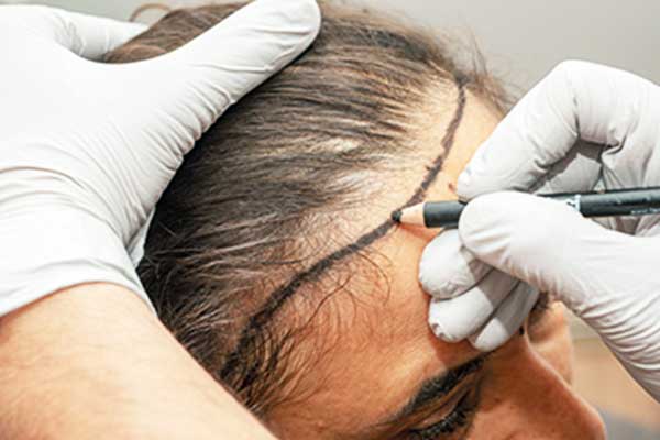 تقنية زراعة الشعر DHI في تركيا : دليل شامل لزرع الشعر
