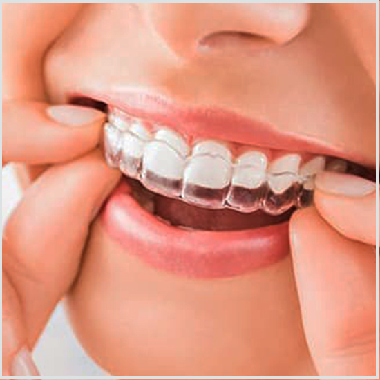 تقويم الأسنان الشفاف: الحل الأمثل لابتسامة جذابة وغير مرئية