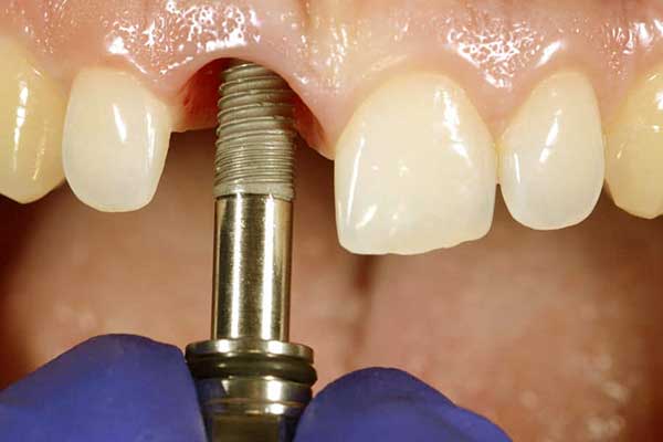 цены на имплантацию зубов в турции : раскрываем доступные цены