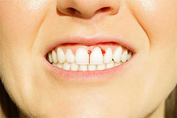 протезирование зубов в турции отзывы : 11 убедительных причин