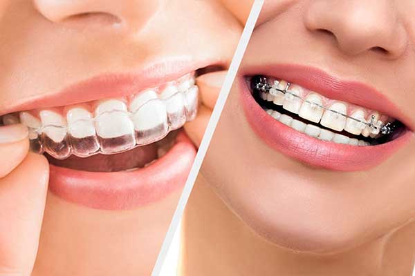 تقويم الأسنان الخزفي: كل ما تحتاج لمعرفته لتحسين ابتسامتك بفعالية