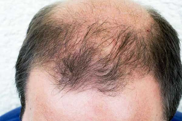 الصلع الأندروجيني : تساقط الشعر الأندروجيني