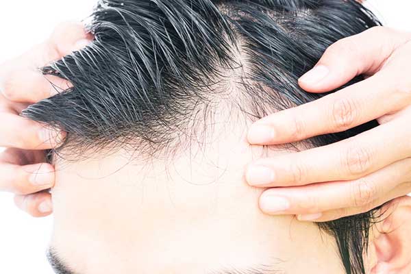 الهرمون المسؤول عن تساقط الشعر عند الرجال: الأسباب والحلول الفعالة