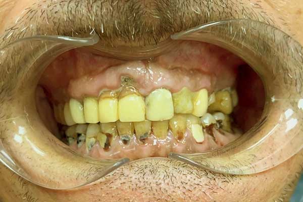 تصبغات الأسنان – الأسباب – العلاج وطرق الوقاية الناجحة