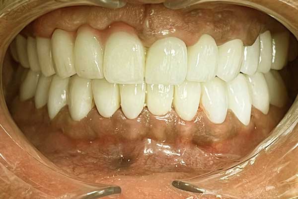 نصائح فعّالة لمواجهة فقدان الأسنان – الأسباب – العلاج والوقاية