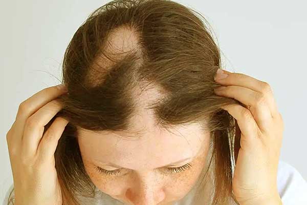 تساقط الشعر: الأسباب والعلاجات والوقاية