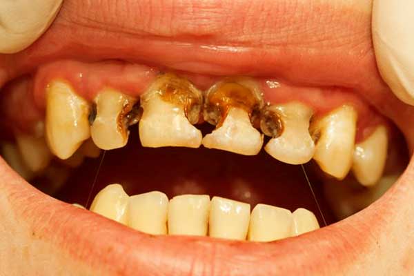 أنواع تلف الأسنان – الاعراض وطرق العلاج الممكنة
